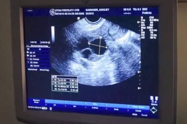 Ashley Gardner mang thai hai cặp song sinh cùng trứng, trường hợp cực hiếm, chỉ chiếm tỷ lệ 1/70 triệu ca mang thai. Ảnh: Mirror