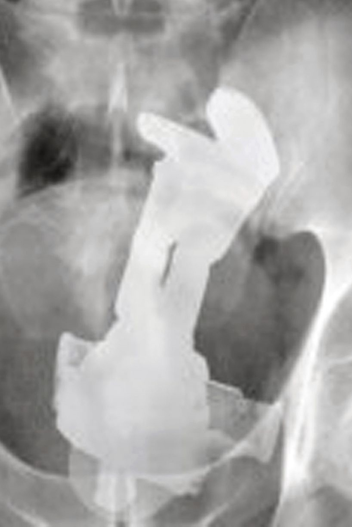 Đồ chơi phát sáng trong ruột bệnh nhân.