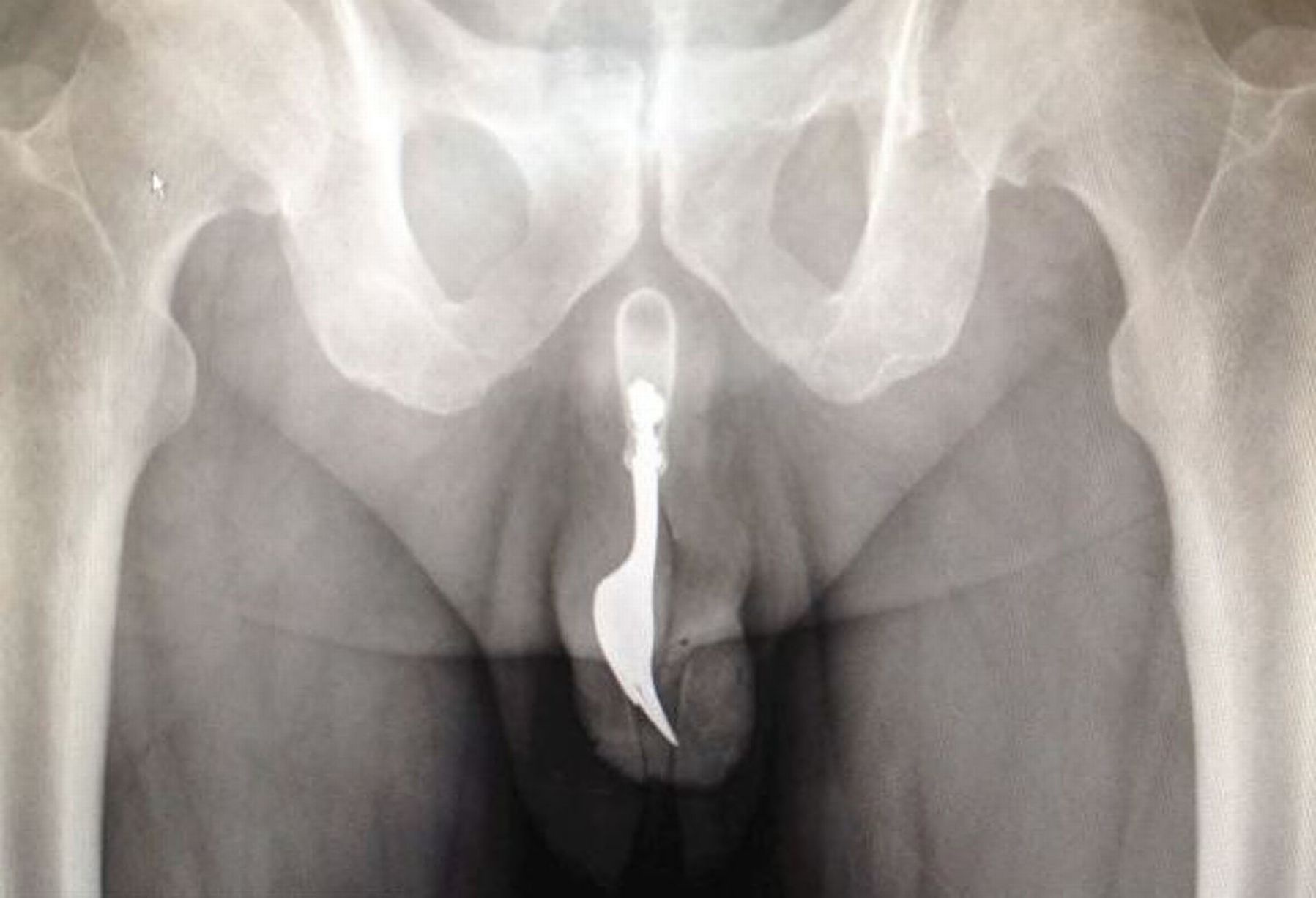 Dĩa kim loại mắc kẹt trong dương vật một người đàn ông.