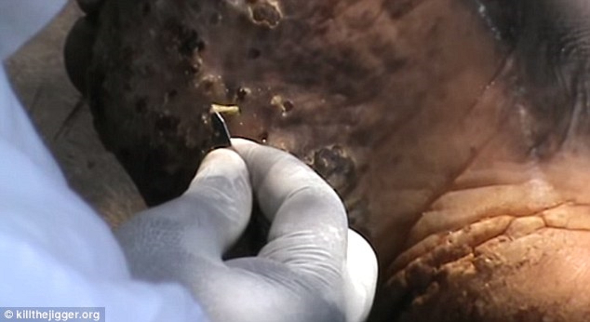 Nhân viên y tế dùng dao loại bỏ bọ chét khỏi chân bệnh nhân, để lại vết thương sâu. Đây là một quá trình đau đớn và hầu như không thể lấy hết Jigger trong một lần. Ở Kenya, người ta ước tính khoảng 1,4 triệu người nhiễm bọ chét.