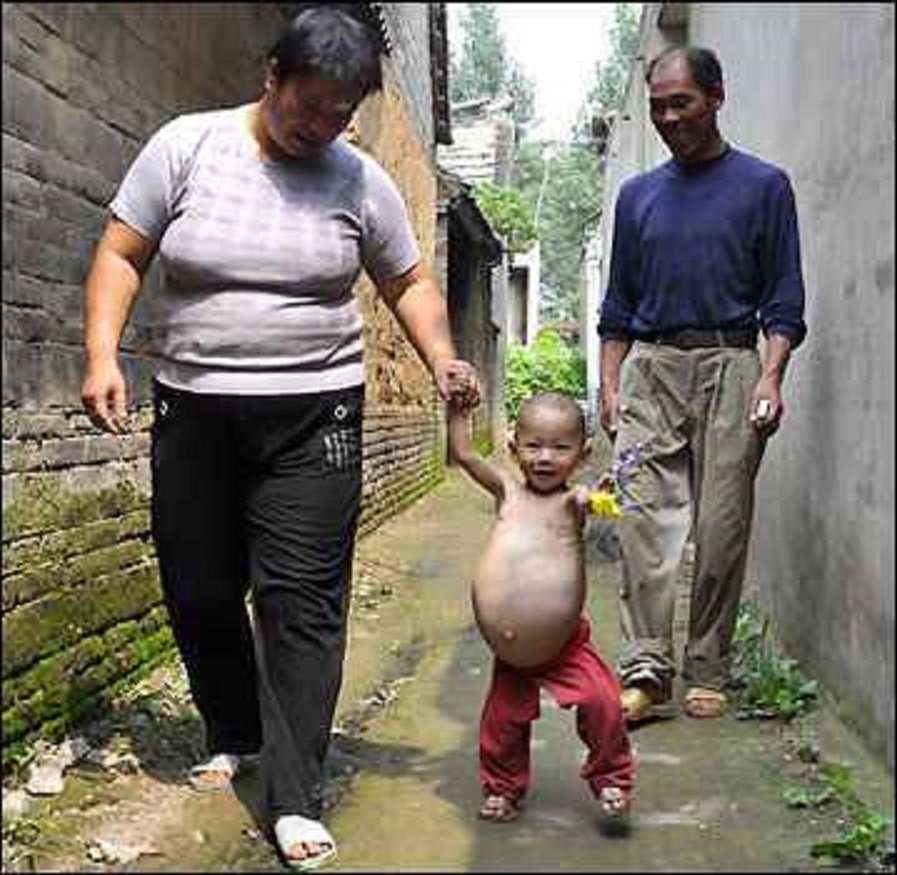 Đứa bé chào đời cùng với một bào thai ký sinh trong cơ thể. Ảnh: Blogspot..com