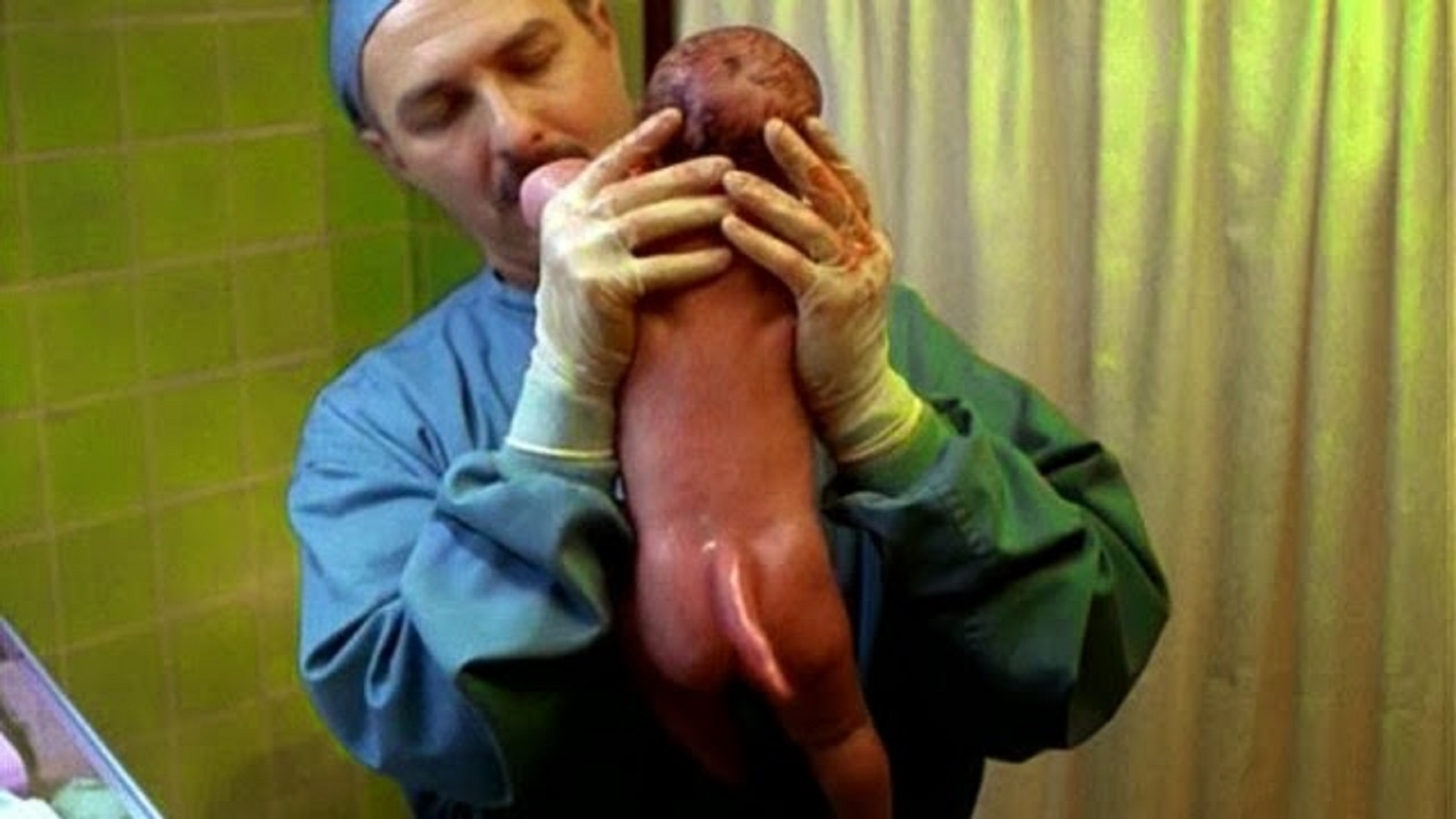 Đứa bé dị dạng bẩm sinh với một chiếc đuôi. Ảnh: Blogspot.com