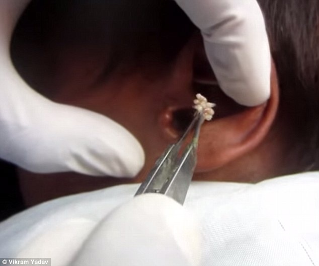 Gioi an nau trong tai nguoi do ruoi de trung hinh anh