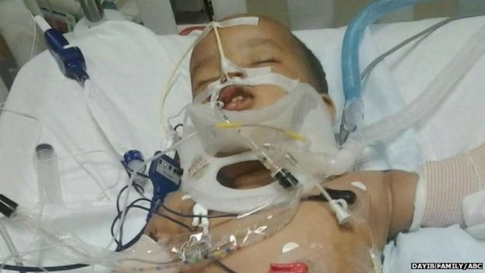 Musa chấn thương nghiêm trọng sau khi ngã xuống từ độ cao 30 mét nhưng em vẫn sống sót một cách kỳ diệu. Ảnh: BBC