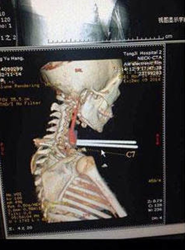 Tấm ảnh chụp X quang cho thấy đôi đũa không đâm trúng bất kỳ cơ quan nào trong cơ thể Jun Chia.