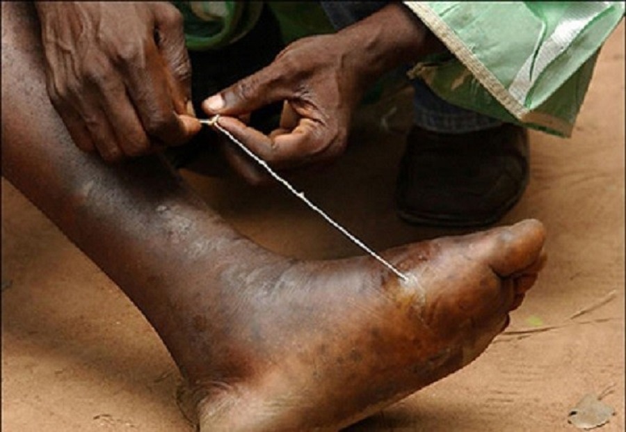 Qua trinh keo giun guinea tu chan nguoi hinh anh