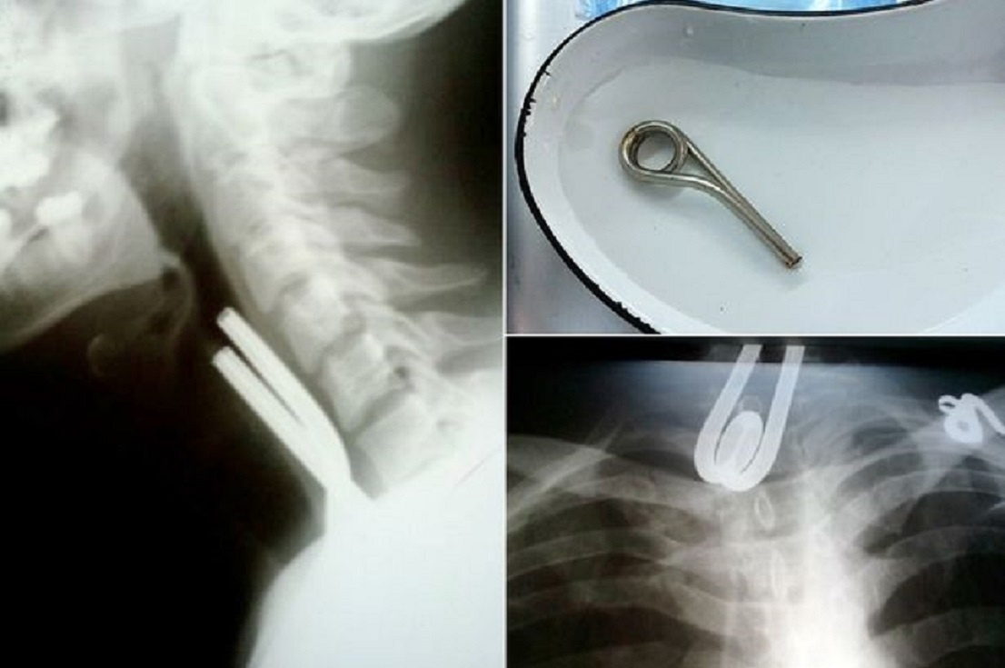 Day kim loai ket trong thuc quan khi an hinh anh