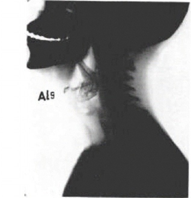 Hình chụp X-quang cá sống mắc kẹt trong cổ họng một thiếu niên ở Pakistan năm 1965. Ảnh: