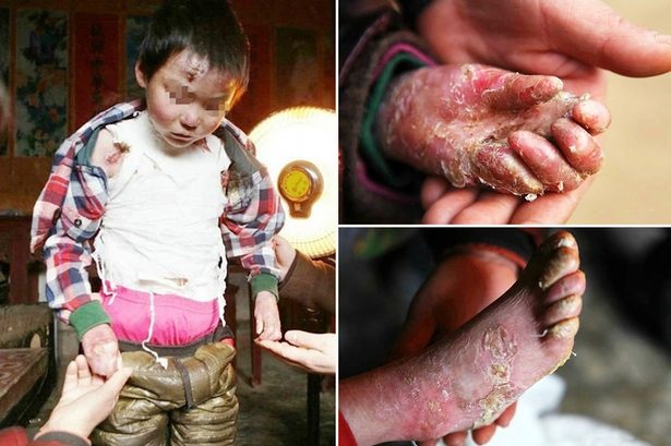 Cậu bé Song Liuchen với căn bệnh hiếm gặp về da. Ảnh: Cen