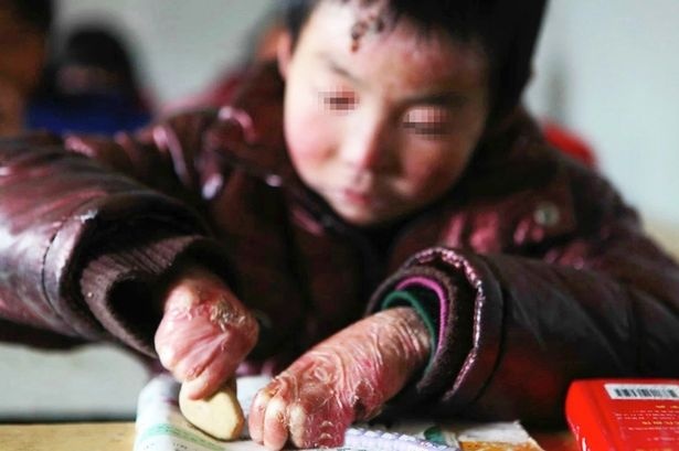 Hằng ngày, cậu bé chống chọi với sự đau đớn, nỗ lực đên trường học tập. Ảnh: Cen