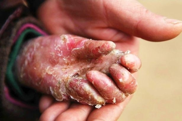 Thieu nien hoc gioi du mac benh lo loet khap co the hinh anh