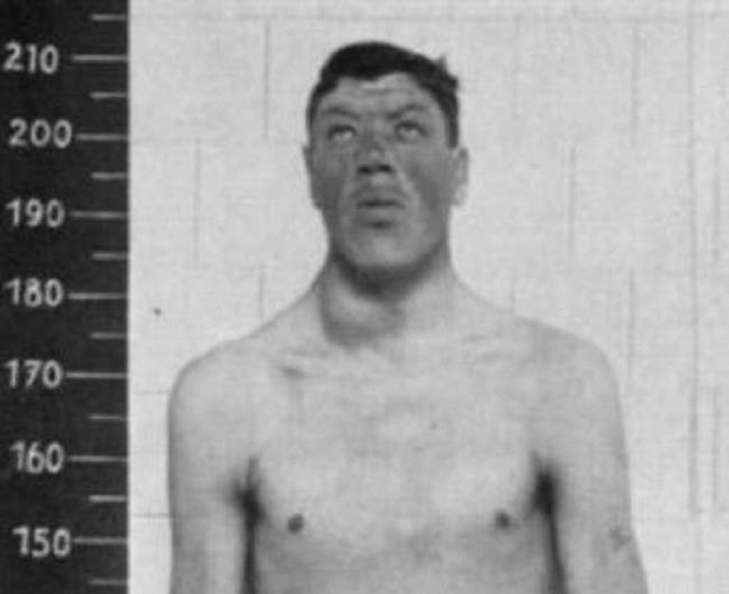 Nguoi lun phat trien thanh nguoi khong lo vi benh hiem hinh anh