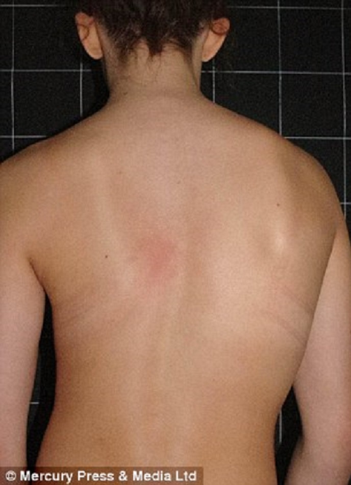 Sau khi đột ngột cao lên 15 cm, xương bả vai một bên của Lauren bắt đầu phát triển lệch. Ảnh: 