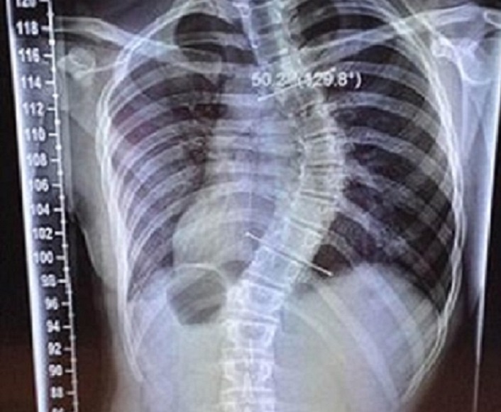 Xuong song thieu nu cong vi chieu cao tang dot ngot hinh anh