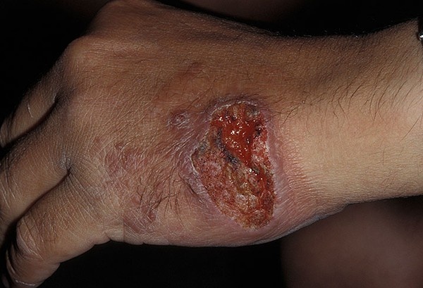 Hang loat chien binh IS nhiem khuan loet thit hinh anh