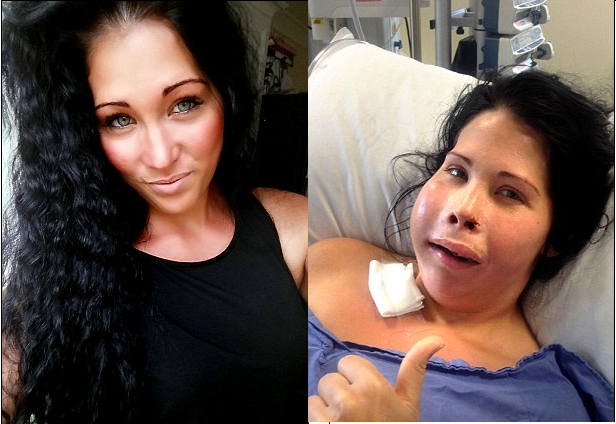 Mat nua khuon mat vi ung thu tuyen nuoc bot hinh anh