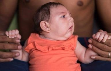 Nhung nan nhan ti hon cua virus gay teo nao Zika hinh anh