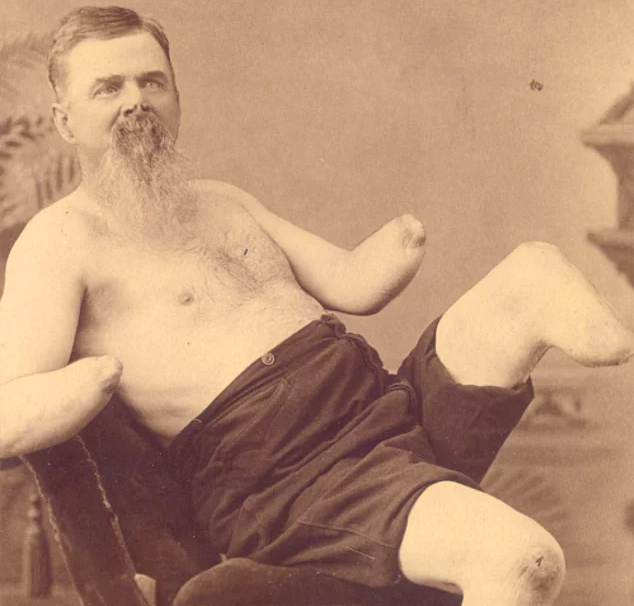 Nhung vu cat bo tay chan tren the gioi anh 4