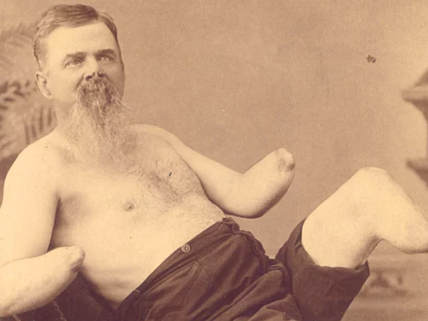 Nhung vu cat bo tay, chan rung ron tren the gioi hinh anh