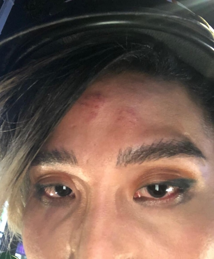 Tài xế Go-Viet nói vết thương trên trán Mid Nguyễn là mụn bọc ảnh 2 Tai xe Go-Viet noi vet thuong tren tran Mid Nguyen la mun boc anh 2