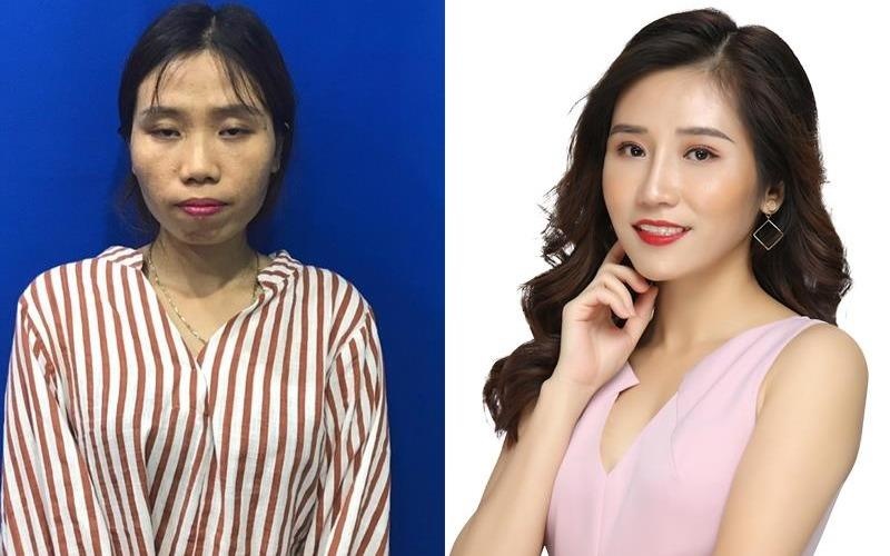 Co gai tim duoc tinh yeu sau khi 'dap di xay lai', chinh sua nhan sac hinh anh