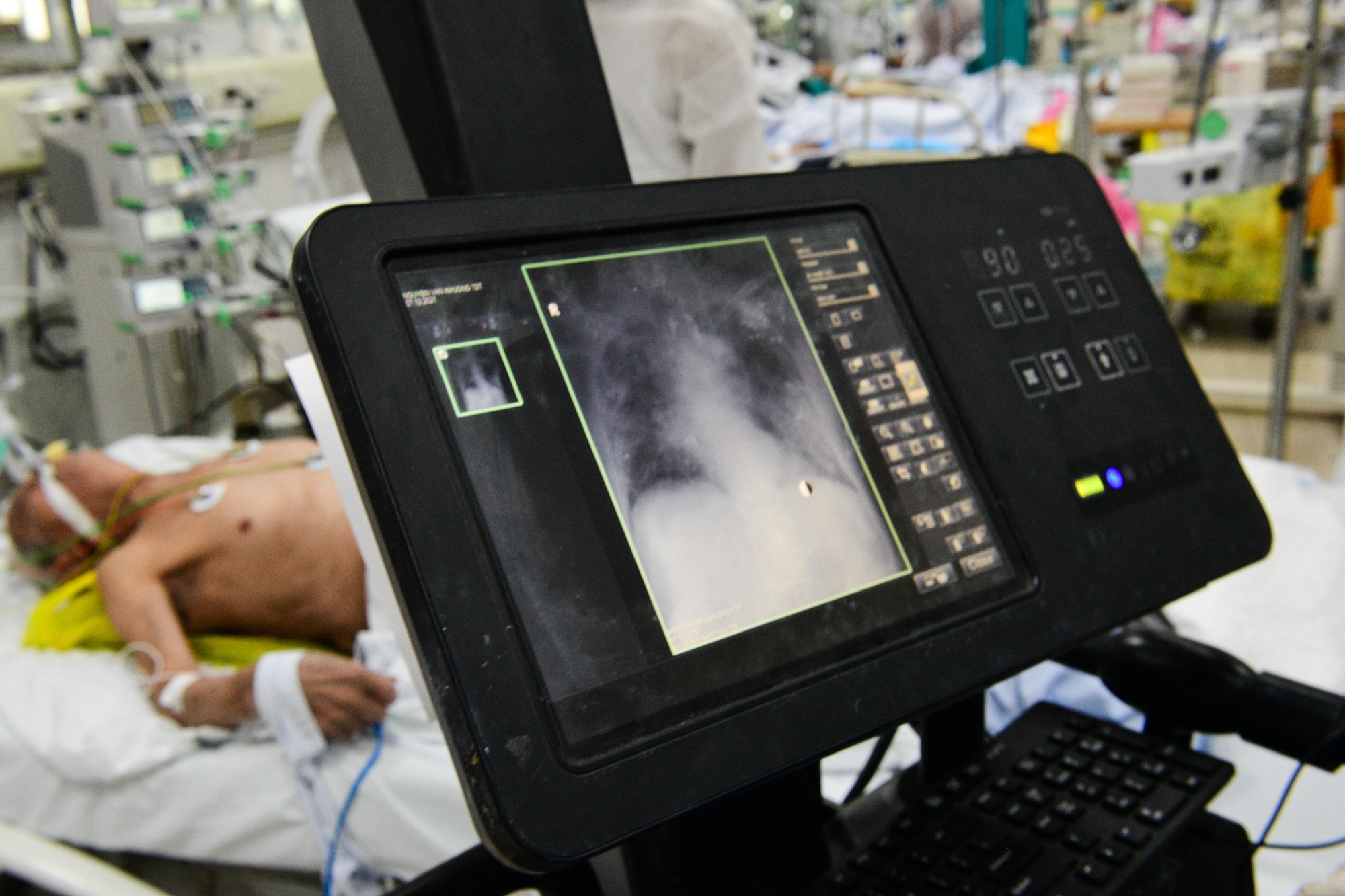 khoa cap cuu benh vien nhiet doi trung uong,  cap cuu F0 anh 6