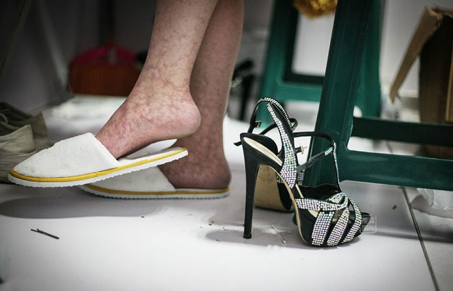 Áp lực từ công việc và hậu quả đứng quá lâu trên những đôi giày cao gót thể hiện rõ trên những đôi chân dài của mẫu ô tô. Nhiều người đẹp đã mắc phải căn bệnh giãn tĩnh mạch rất đáng sợ như thế này.