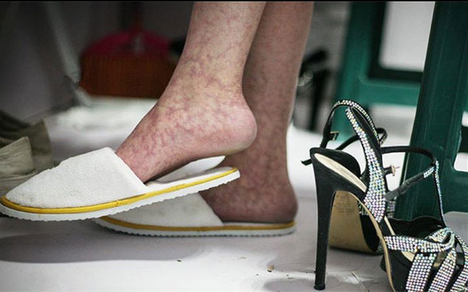 Chịu đựng hàng giờ với đôi giày cao gót, nhiều người mẫu đã mắc phải hội chứng giãn tĩnh mạch rất đáng sợ.