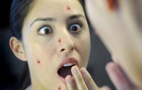 5. Nốt mụn bất ngờ: Thi thoảng bạn thường bị nổi mụn bất ngờ. Để giải quyết chúng nhanh gọn mà không gây kích ứng cho da, bạn có thể dùng một túi trà xanh nhúng nước ấm và đắp vào nốt mụn. Trong trà xanh có chứa catechins là một chất chống oxy hoá giúp kháng viêm đồng thời độ ấm của túi trà có thể giúp tuần hoàn máu xung quanh nốt mụn khiến da mau lành hơn.