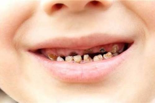 8 thuc pham giup ngan ngua sau rang hinh anh