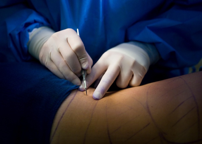 Các bác sĩ sẽ hút mỡ từ dạ dày, đôi khi ở cả phần cánh tay, bả vai, lưng và thắt chặt da để tạo hình cơ bắp “ngồn ngộn” như mong ước của khách hàng. Dù đây là kiểu làm đẹp cấp tốc không cần ăn kiêng hay tập luyện khắc nghiệt, nhưng giá cho một ca phẫu thuật kiểu này không hề rẻ, đến hơn 12 nghìn bảng Anh cho một lần thực hiện.