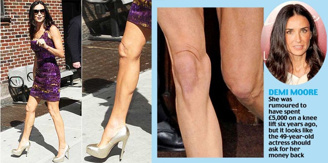 4. Phẫu thuật căng da vùng đầu gối. Các phẫu thuật thẩm mỹ thông thường hầu như chỉ tập trung vào các khu vực được đánh giá có ảnh hưởng quan trọng đến sức hấp dẫn của cả phái nam lẫn nữ như mặt, ngực, mông hoặc vùng bụng. Tuy nhiên trong vài năm qua, có một loại phẫu thuật kỳ lạ đã xuất hiện và thu hút không ít người thực hiện, đó là phẫu thuật căng da vùng đầu gối.