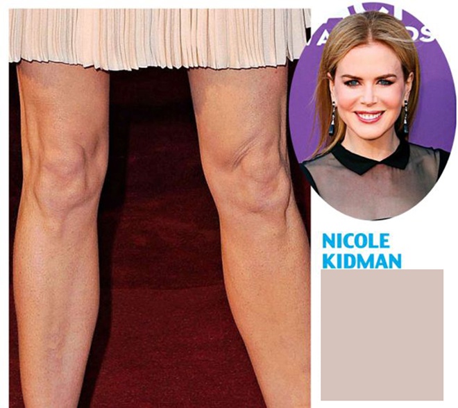 Bằng cách loại bỏ da thừa và các nếp nhăn hình thành quanh đầu gối do tuổi tác, phẫu thuật căng đầu gối sẽ giúp phái đẹp nhanh chóng sở hữu đôi chân và vùng gối thon gọn, trẻ trung hơn. Dù vậy, đây vẫn là kiểu làm đẹp được đánh giá xa xỉ, tốn kém chỉ dành cho giới nhà giàu “nhiều tiền lắm của” và các ngôi sao Hollywood như Demi Moore, Jennifer Aniston, Nicole Kidman …