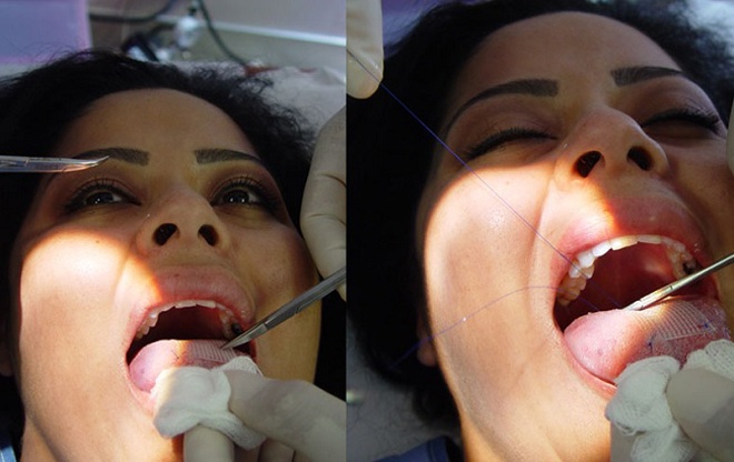 Dù đang bị chỉ trích là phản khoa học và có thể kéo theo hàng loạt hệ lụy về sức khỏe, nhưng biện pháp ăn kiêng kỳ lạ này vẫn nhận được sự ủng hộ của vô số chị em muốn có được vóc dáng lý tưởng nhưng không phải vất vả vì tập luyện thể dục.