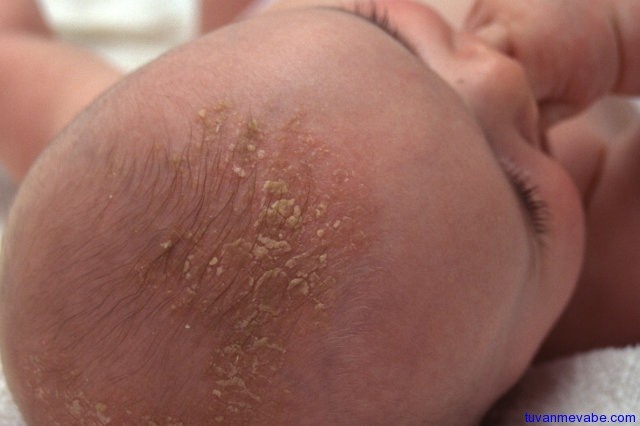 Cac van de ve da thuong gap o tre so sinh hinh anh