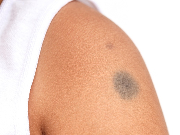 Bớt: Đây là vấn đề rất phổ biến ở trẻ sơ sinh. Các dấu mạch sinh (vết cò mổ) thường làm các bậc cha mẹ rất lo lắng. Tuy nhiên, các dấu hiệu này sẽ mất dần trong một vài tháng đến nhiều năm. Tuy nhiên, các vết bớt màu đỏ rượu trên mặt có thể cần điều trị laser và thẩm mỹ ở tuổi trưởng thành.