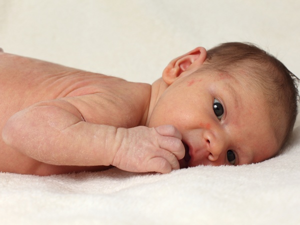 Eczema: Eczema xảy ra phổ biến ở các bé khoảng 2-3 tháng tuổi hoặc thậm chí muộn hơn. Biểu hiện của chúng thường là một vùng đỏ ngứa trên má hoặc vùng ngực. Những em bé này thường có làn da rất khô, và nó không phải là do bị lây từ cha mẹ.  Hình thức này thường được gọi là bệnh chàm dị ứng. Bạn nên sử dụng xà phòng nhẹ nhàng, các loại kem dưỡng ẩm có độ pH trung tính. Các bác sĩ da liễu có thể kê một loại kem steroid hoặc thuốc chống viêm giai đoạn ngắn để kiềm hãm khi bệnh phát triển mạnh.