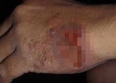 Su nguy hiem cua vi khuan dang tan cong IS hinh anh