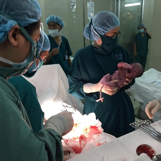 Ca mổ bắt thai diễn ra sáng 22/4