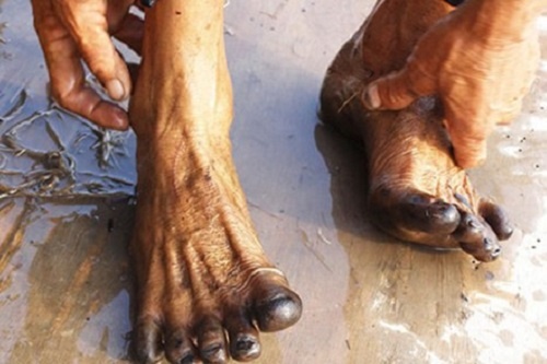 Hien tuong la: Chan den thui sau khi loi ruong hinh anh