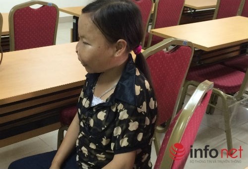 Bệnh nhân Phan Thị Vân quê Cao Bằng đã 21 tuổi nhưng trông cô như trẻ con.