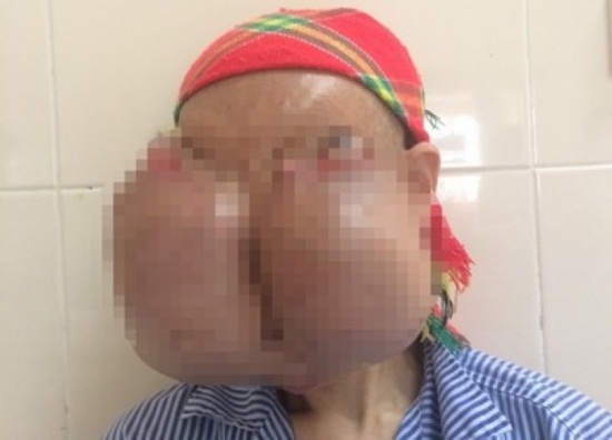 Khuon mat moi cho nguoi phu nu co khoi u khong lo hinh anh