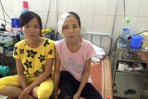 Ung thu da lai dap thuoc nam, bien chung vao tan xuong hinh anh