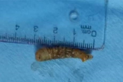 Gap sau dai 3 cm song trong mat benh nhan hinh anh