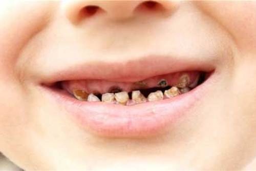 Can benh khien moi nguoi Viet Nam mat hon 6 chiec rang hinh anh