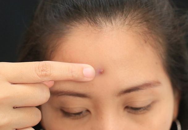 1. Quyết định xem có nên nặn mụn Chỉ nên nặn với mụn đầu trắng, thường là có mủ dưới da, nó sẽ dễ dàng nặn cũng như điều trị chăm sóc và cũng ít để lại sẹo.