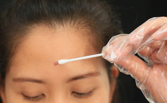 10. Bôi thuốc sau khi nặn Bạn nên bôi thuốc chứa benzoyl peroxide sau khi nặn để loại bỏ vi khuẩn, tuyệt đối không sử dụng kem đánh răng như kinh nghiệm truyền miệng vì nó gây hại cho da.