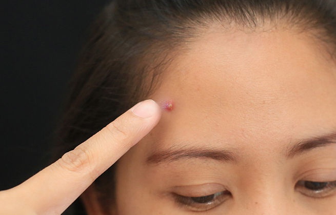 2. Không nặn mụn bừa bãi Nên nặn khi mụn đầu trắng đã quá ba ngày và đã sẵn sàng để thoát ra ngoài. Tuyệt đối tránh nặn các nốt mụn to và gây cảm giác đau đớn vì nó dễ dẫn đến nhiễm trùng.