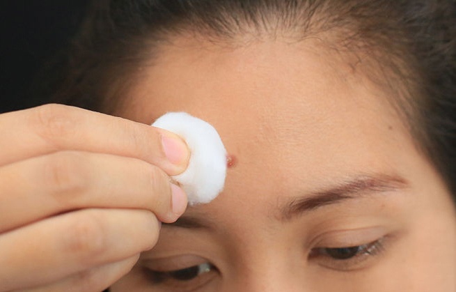 4. Làm sạch vùng da xung quanh mụn Sử dụng sữa rửa mặt kháng khuẩn hoặc thấm cồn vào bông để lau nhẹ nhàng, tránh chà xát. Sau đó rửa lại với nước ấm và lau khô.