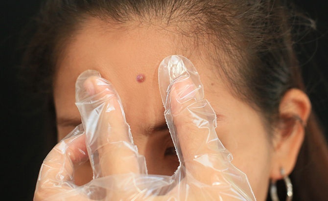 8. Mát xa vùng da quanh mụn Việc này sẽ giúp cho mụn tự đẩy ra ngoài nhanh hơn, tránh dùng tay bóp trực tiếp vào mụn, nó sẽ gây ra máu và sẹo thâm. Trong quá trình mát xa nếu thấy có máu xuất hiện, hãy dừng việc nặn mụn và đợi thêm một thời gian nữa.